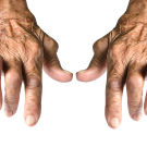 Hands with arthritis