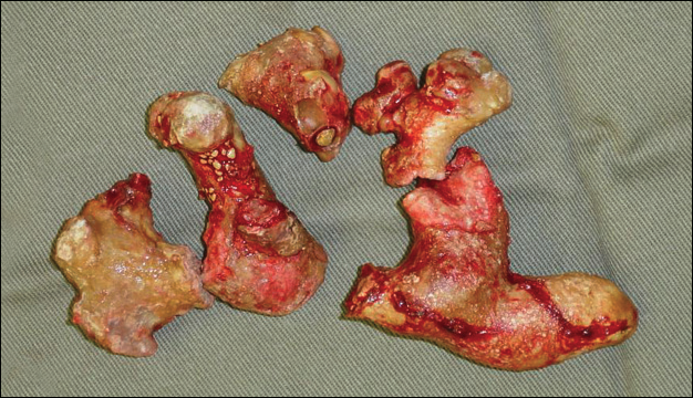 Kidney Stones: Diagnostic and Treatment Strategies