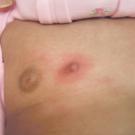 SOLITARY MASTOCYTOMA