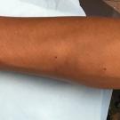 2006C360_Lymphangitis