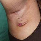 Hidradenitis Suppurativa