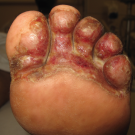 Bacterial Toe Web Infection 