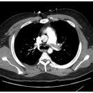 Pulmonary Embolism 