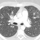 Multisystem Inflammatory Syndrome in Children