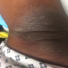 Bilateral Axillary Rash