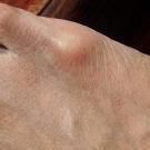 Caterpillar Dermatitis