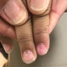 Delayed Nail Findings in Hand-Foot-and-Mouth Disease