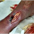 Necrotizing Fasciitis