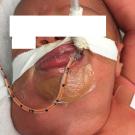 Cervical Teratoma in a Newborn