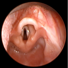 Laryngeal Cleft Type I