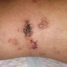 Lymphangioma Circumscriptum