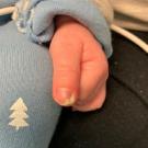 Paronychia in a Neonate