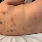 Chronic, Progressive, Bruise-Like Lesions on a Child