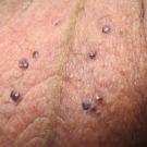 Angiokeratoma of Fordyce presents as multiple, well-circumscribed, dome-shaped papules mainly on the scrotum in men.