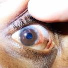 Vernal keratocunjunctivitis