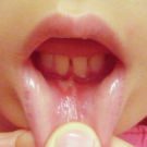 oral ulcer