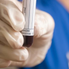 Hyperkalemia blood test